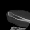 SPORK, NICO - 22.03.1976 - 02.08.2022 - CT obere Extremität - 17:59:38